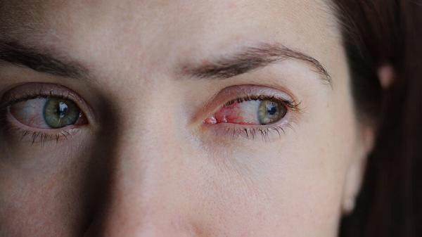 لنزهای تماسی چندبار مصرف خطر یک عفونت نادر چشمی را افزایش می دهند