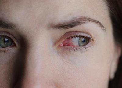 لنزهای تماسی چندبار مصرف خطر یک عفونت نادر چشمی را افزایش می دهند